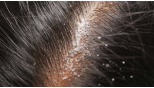 Gros plan de pellicules dans les poils d'un chien